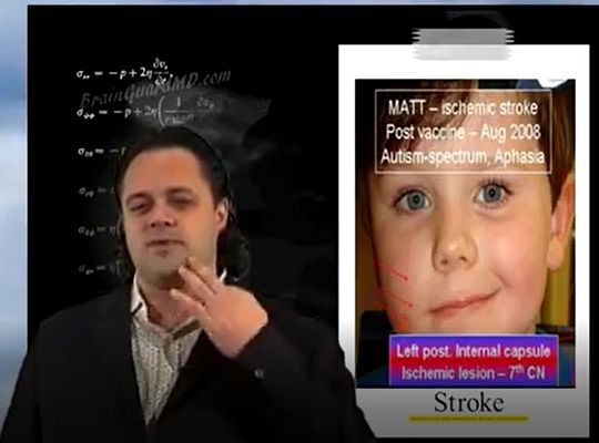 Dr. Andrew Moulden: Stroke jelei oltás után egy gyermeknél, aki autizmus-spektrum-zavarban szenved