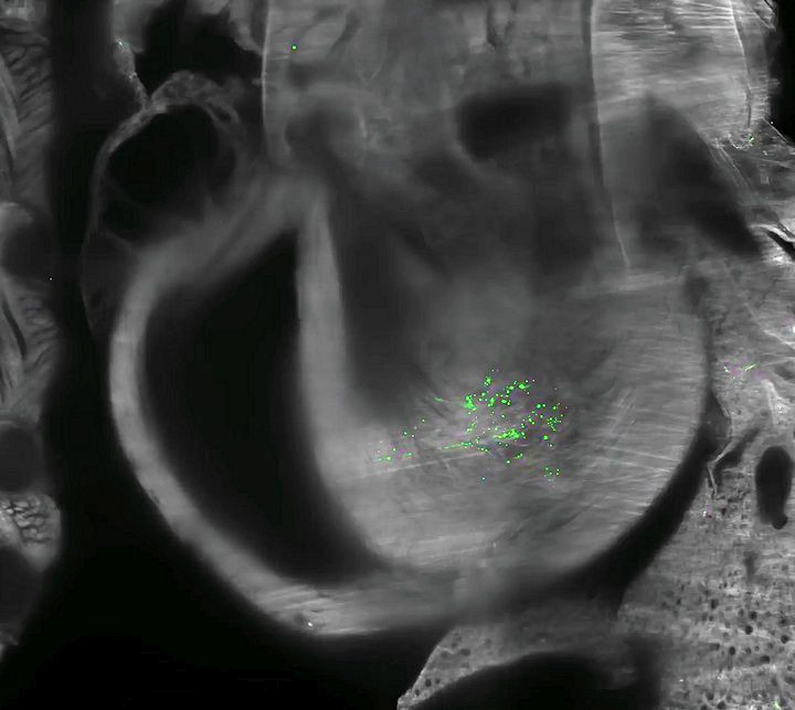 ​Tüskefehérjék ​a koponyacsontvelőben egy SARS-CoV-2-vel fertőzött elhunyt személynél